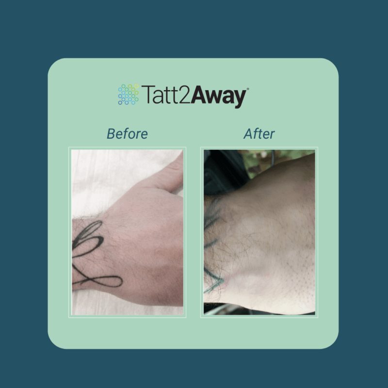 Choosing the Perfect CoverUp Tattoo AU Tatt2Away Nonlaser Tattoo