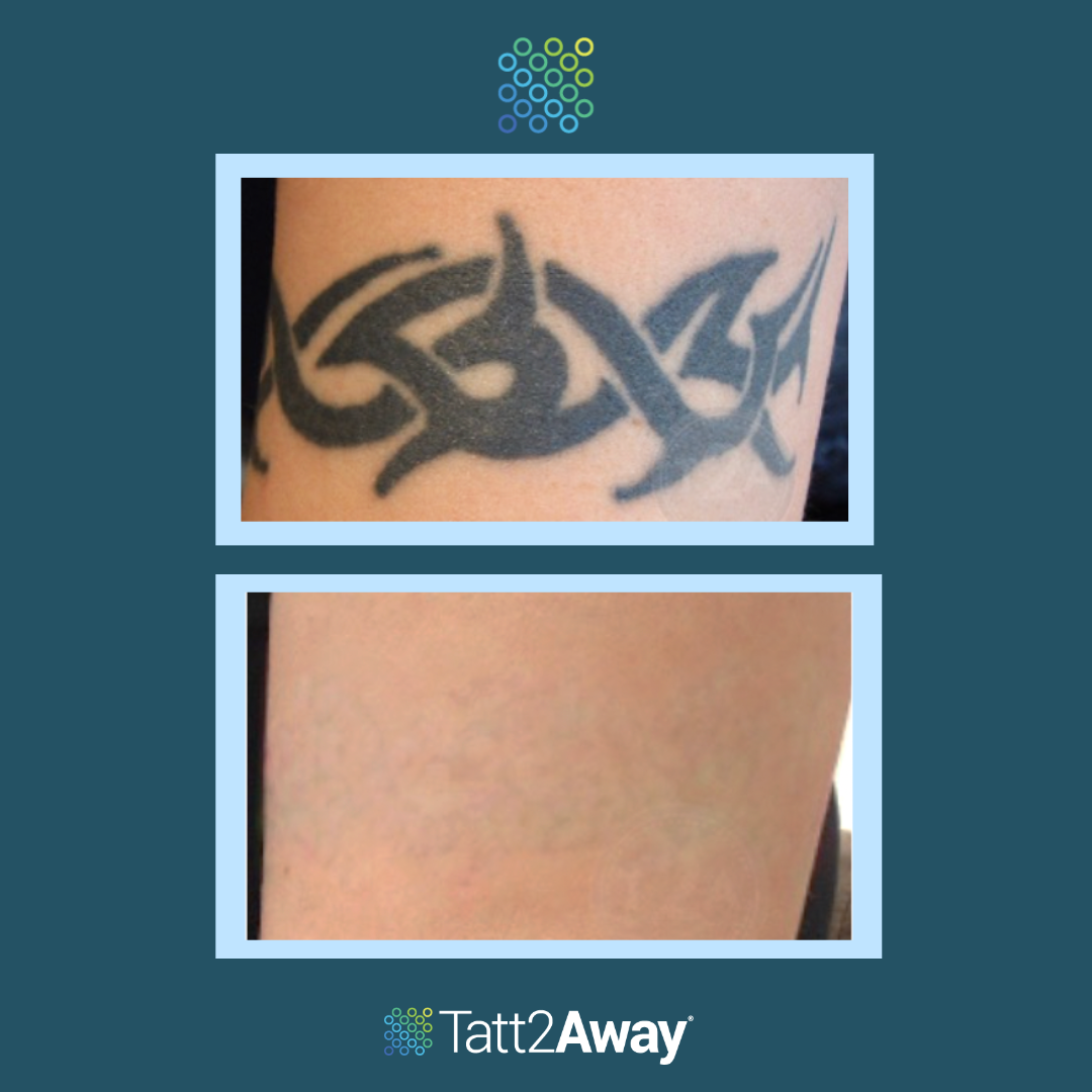 Before & After Pictures - Natural Tattoo Removal - Tatt2Away
