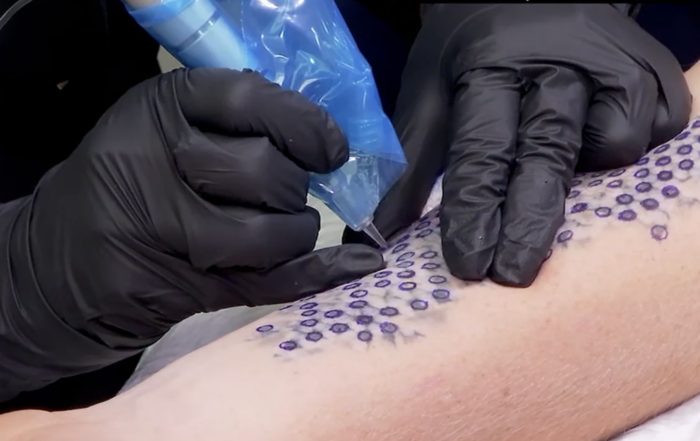 Should You Consider Laser Tattoo Removal