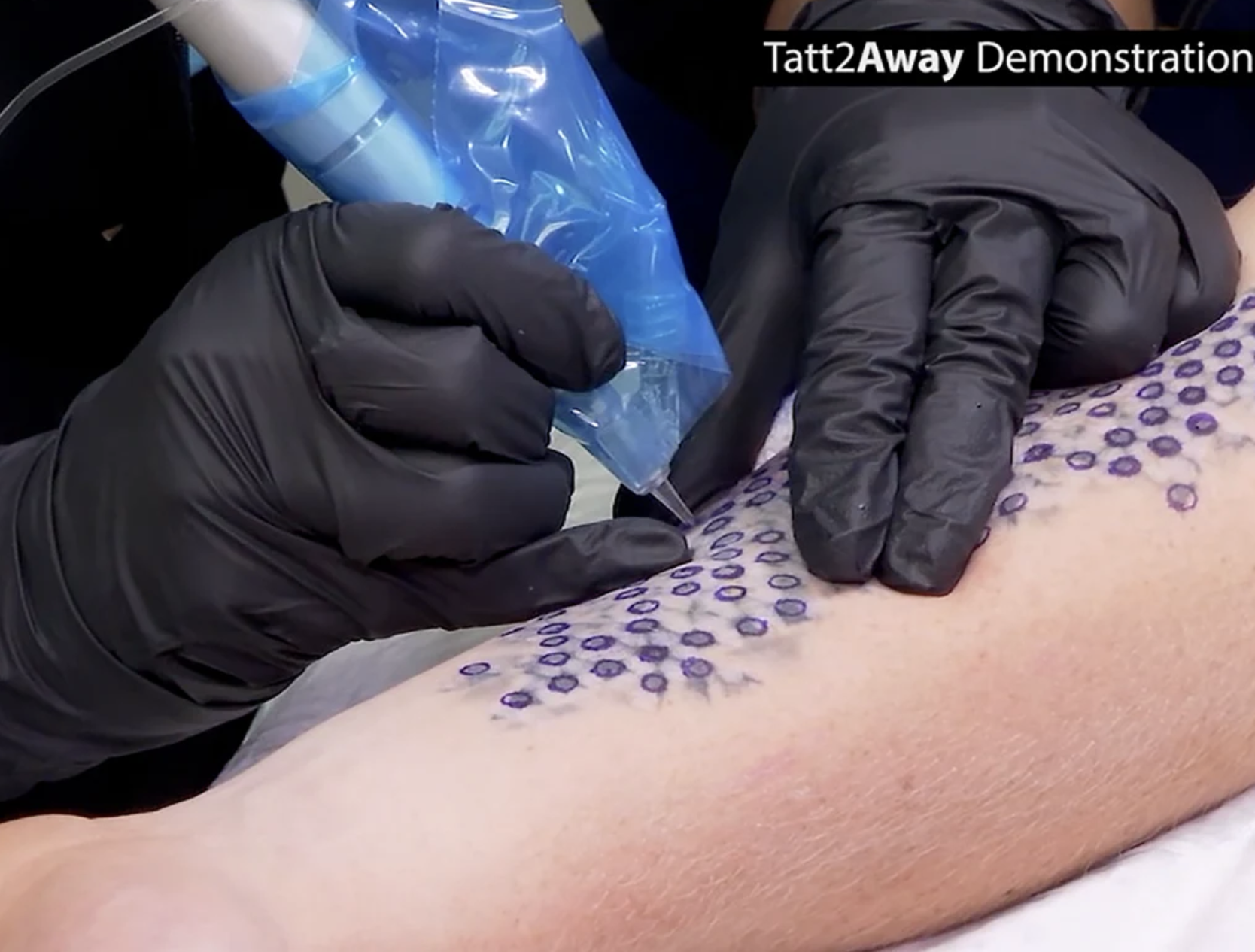 Should You Consider Laser Tattoo Removal? - Tatt2Away
