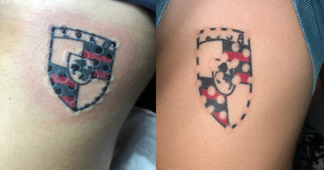 red ink logo tattoo removal