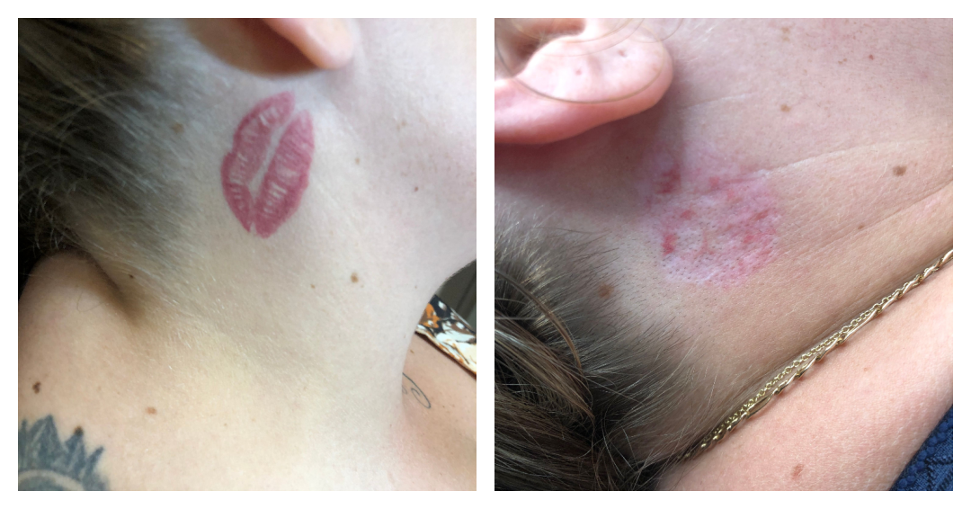 a tattoo of red lips on a womans neck before and after removal