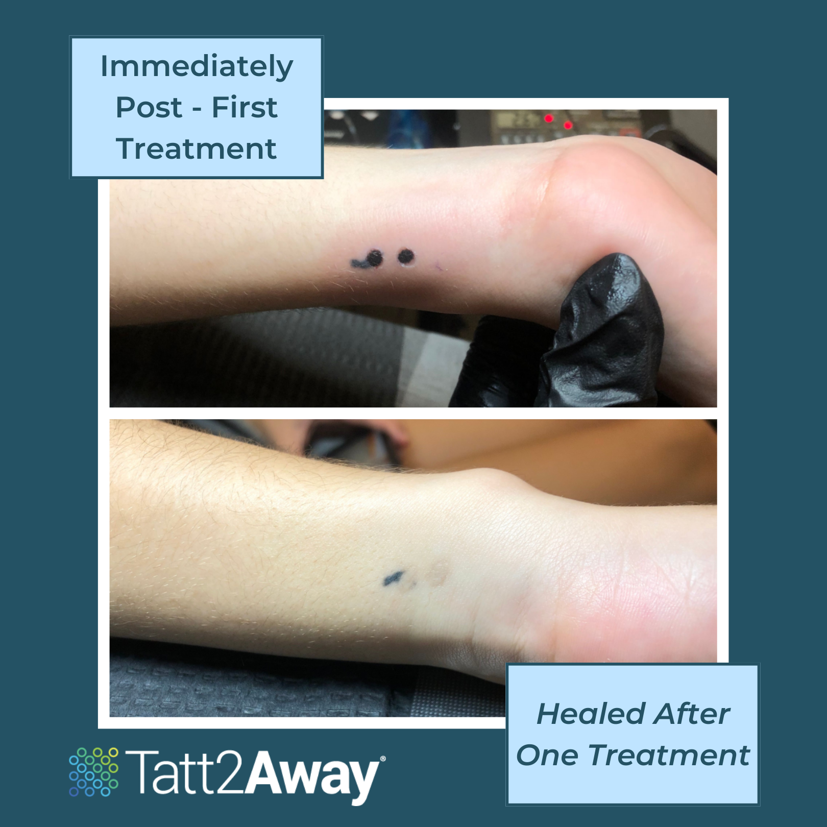 Tatt2Away Process: Immediately Post One Treatment