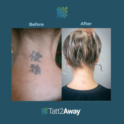 Non-Laser Tattoo Removal And Cover Up | Tatt2Away