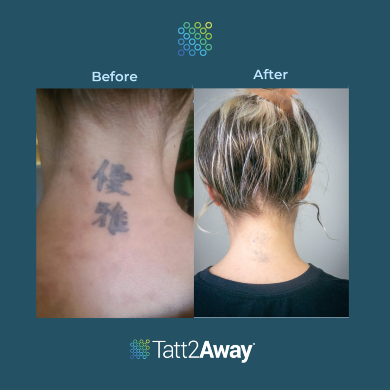 tatt2away non laser tattoo removal before and after pictures