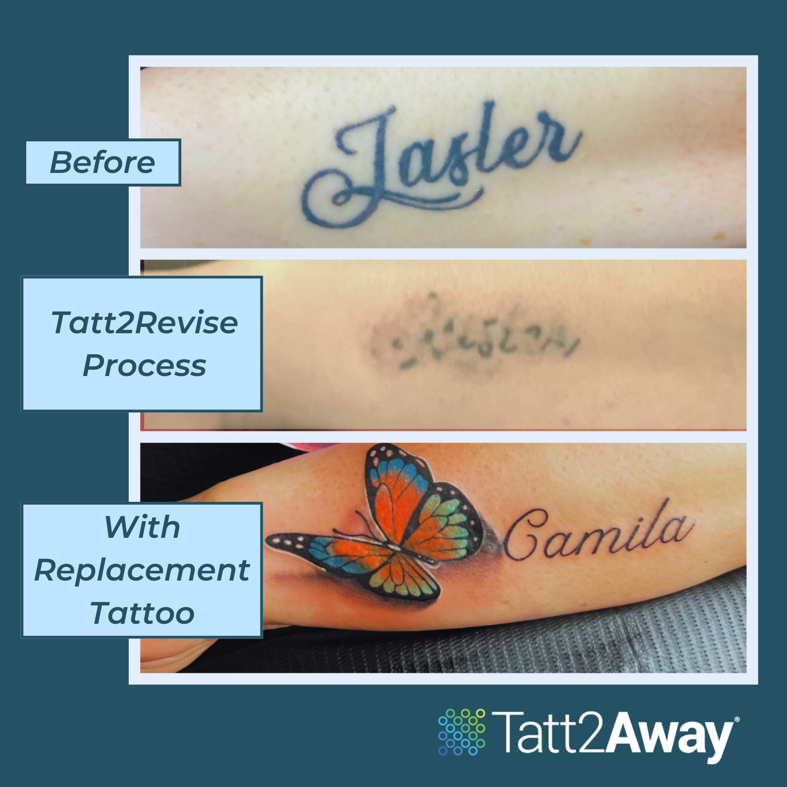Choose Tatt2Revise and Remove Ink from your tattoo each treatment!