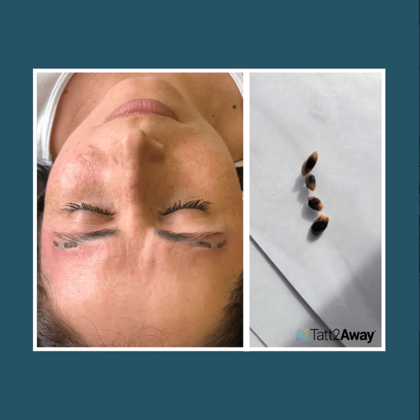 Tatt2Away Brow Ink Removal