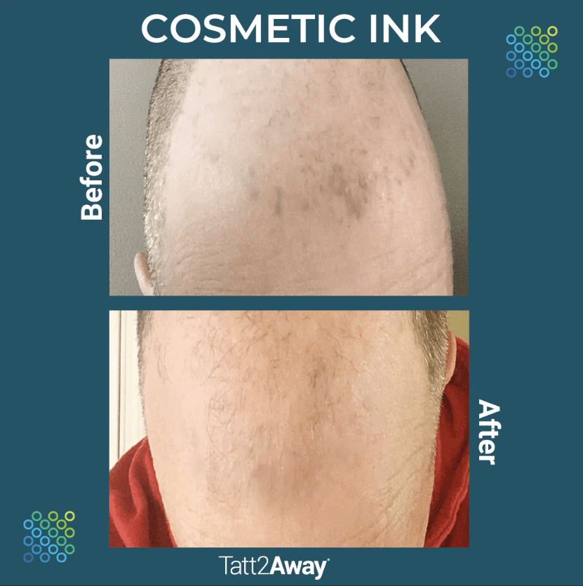 Tatt2Away Cosmetic Ink Before After