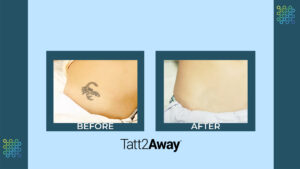 before and after results of removing a tattoo at tatt2away