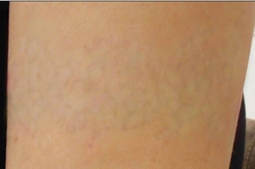 after tattoo removal