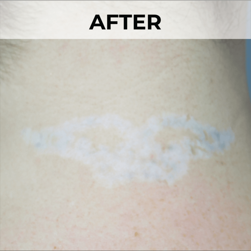 after tattoo removal of angel wings on back of neck