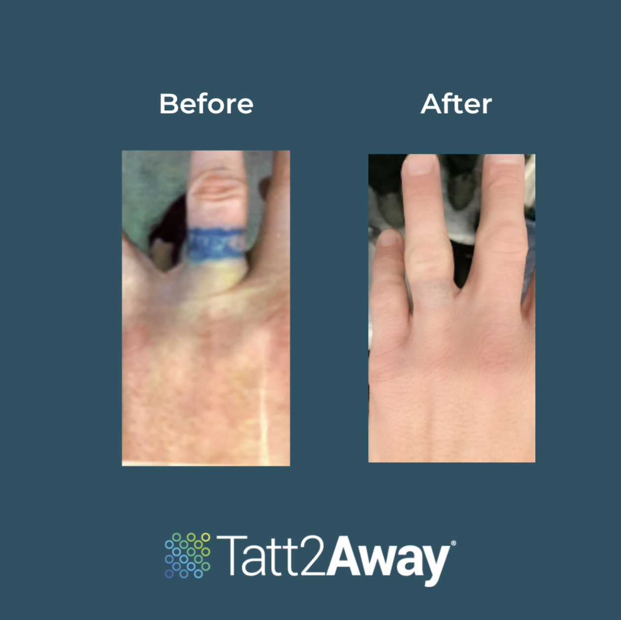 Finger Tattoo Removal Services - Book a Consult - Tatt2Away