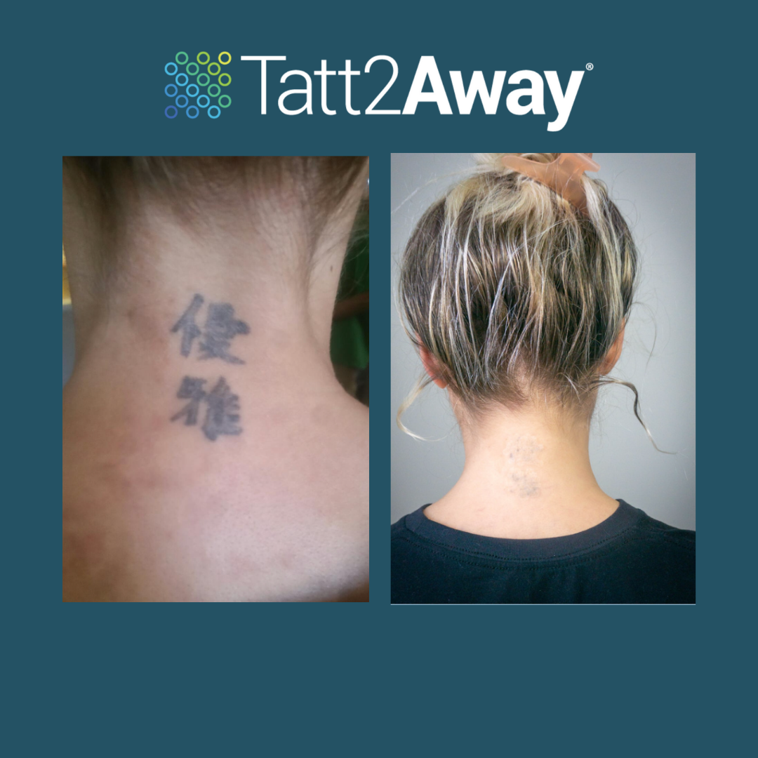 chinese tattoo removal back of neck