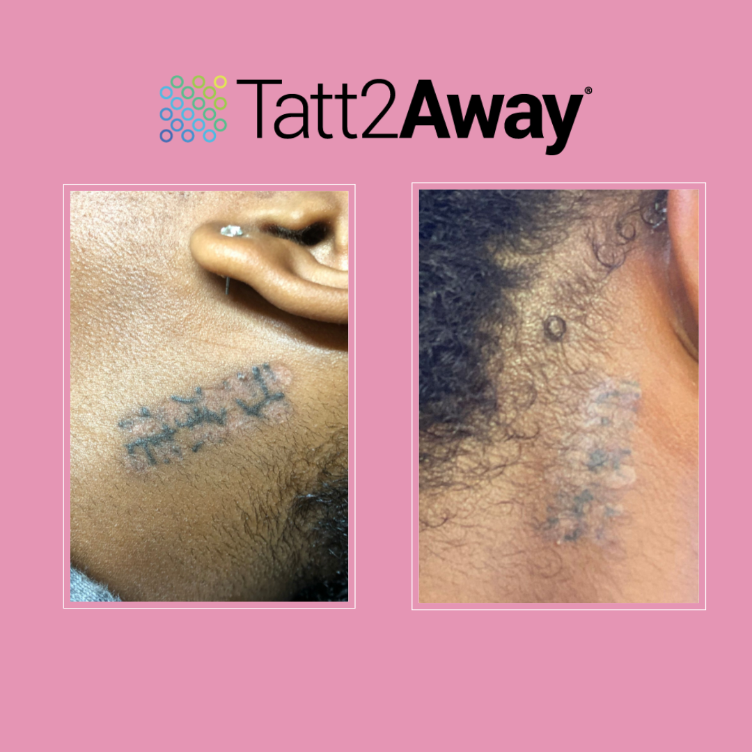 tattoo removal on dark skin