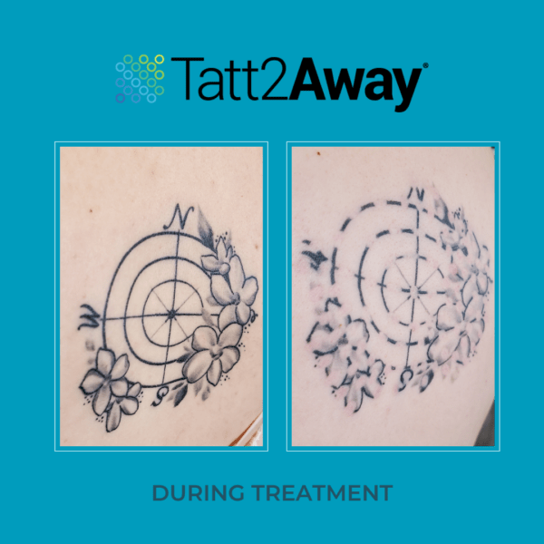 How Much Does Tattoo Removal Cost Laser VS Natural