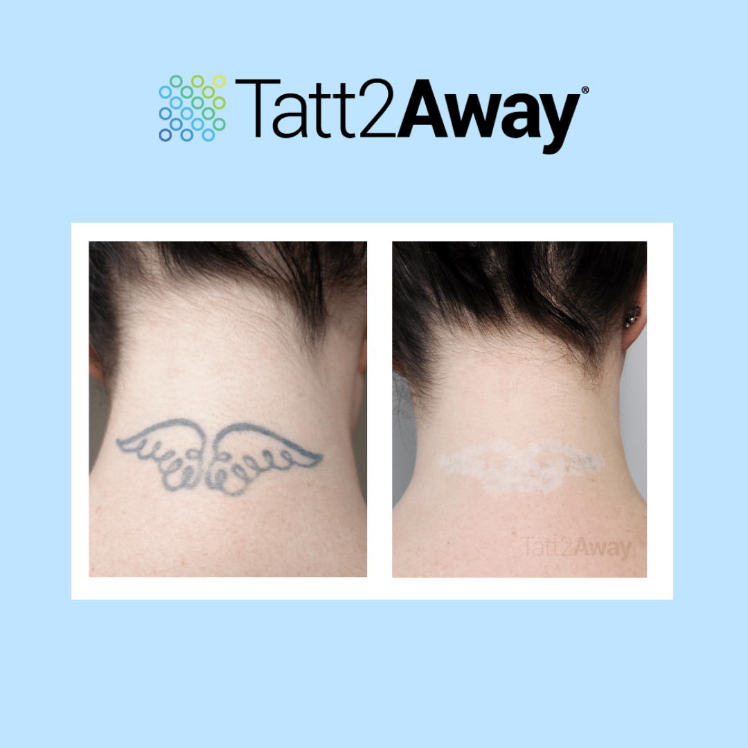 non laser tattoo removal before and after