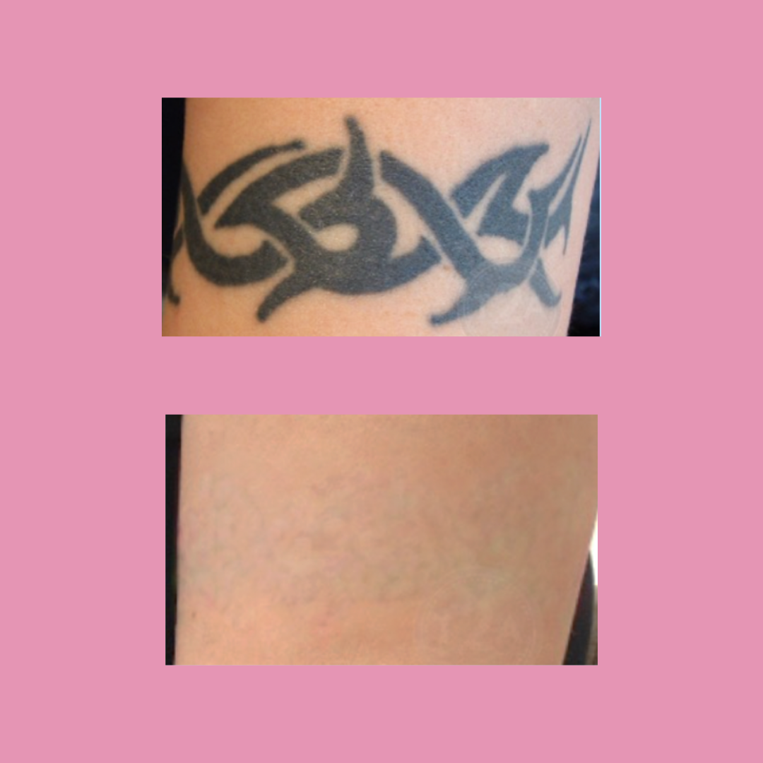 arm tattoo removal before and after