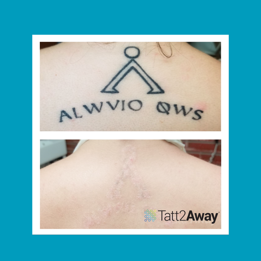 upper back tatto removal before and after