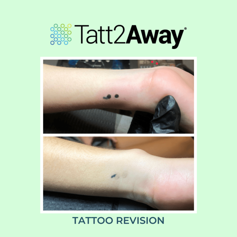 How Much Does Tattoo Removal Cost Laser VS Natural
