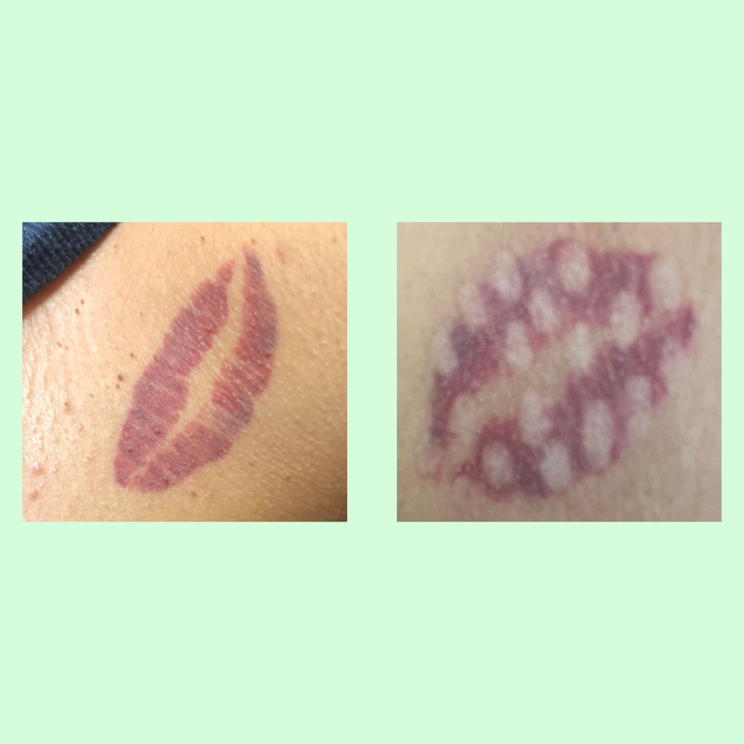 removal of tattoo of red lips