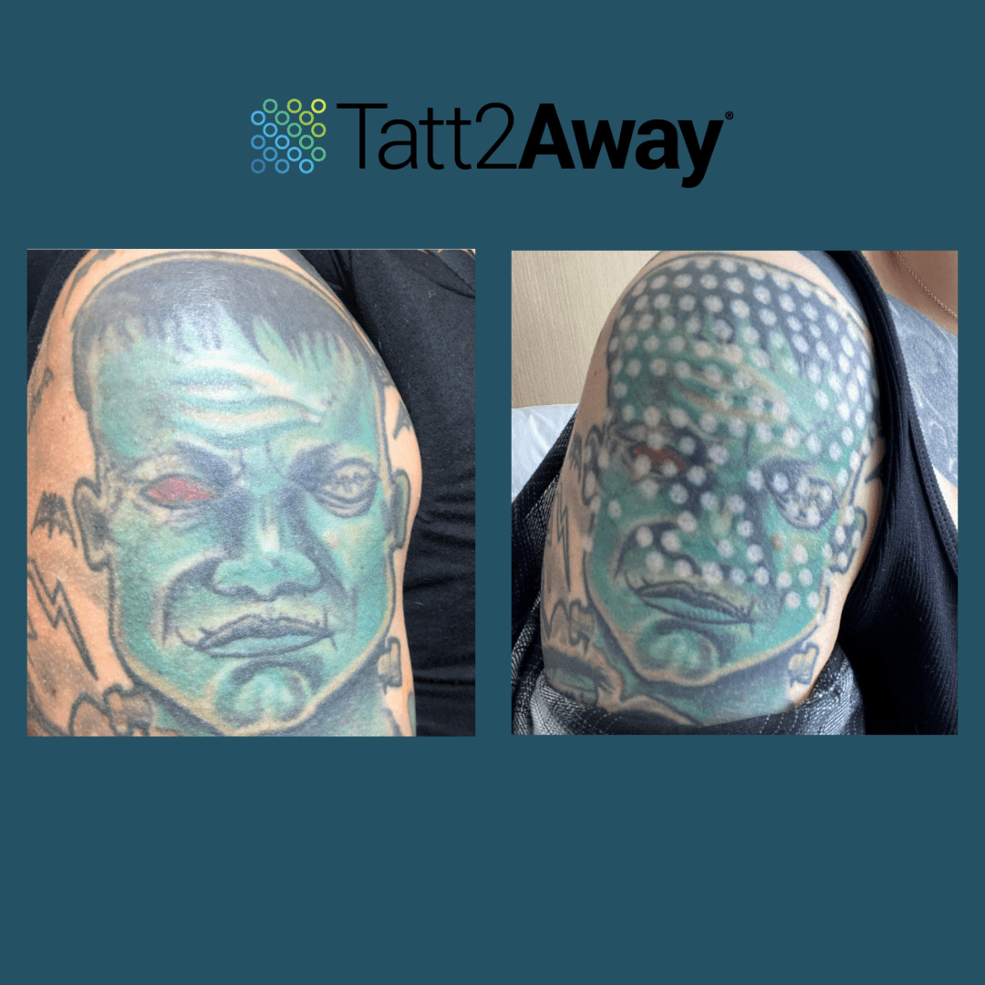 tattoo removal results