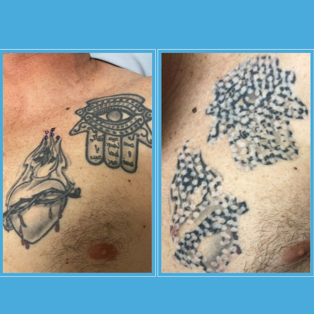 shoulder tattoo removal non laser