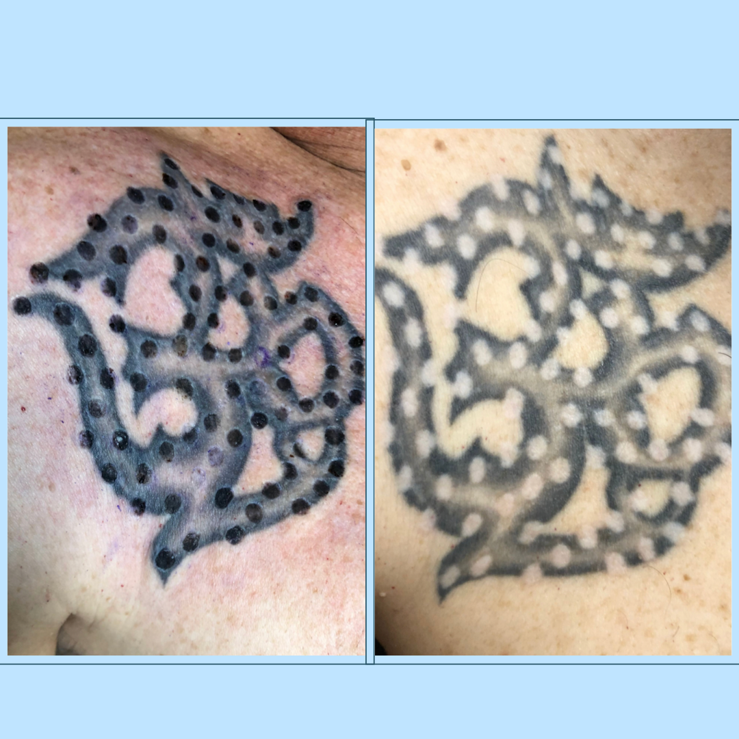 shoulder during tattoo removal