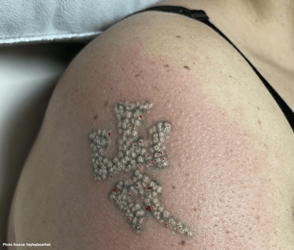 Does Laser Tattoo Removal Hurt The Truth Tatt2Away®