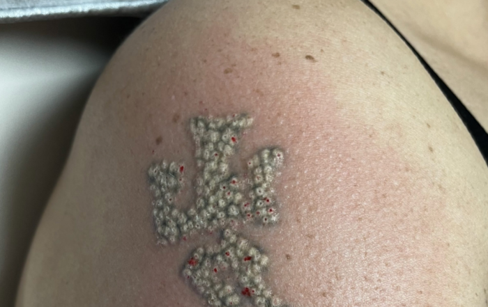 laser tatooo removal