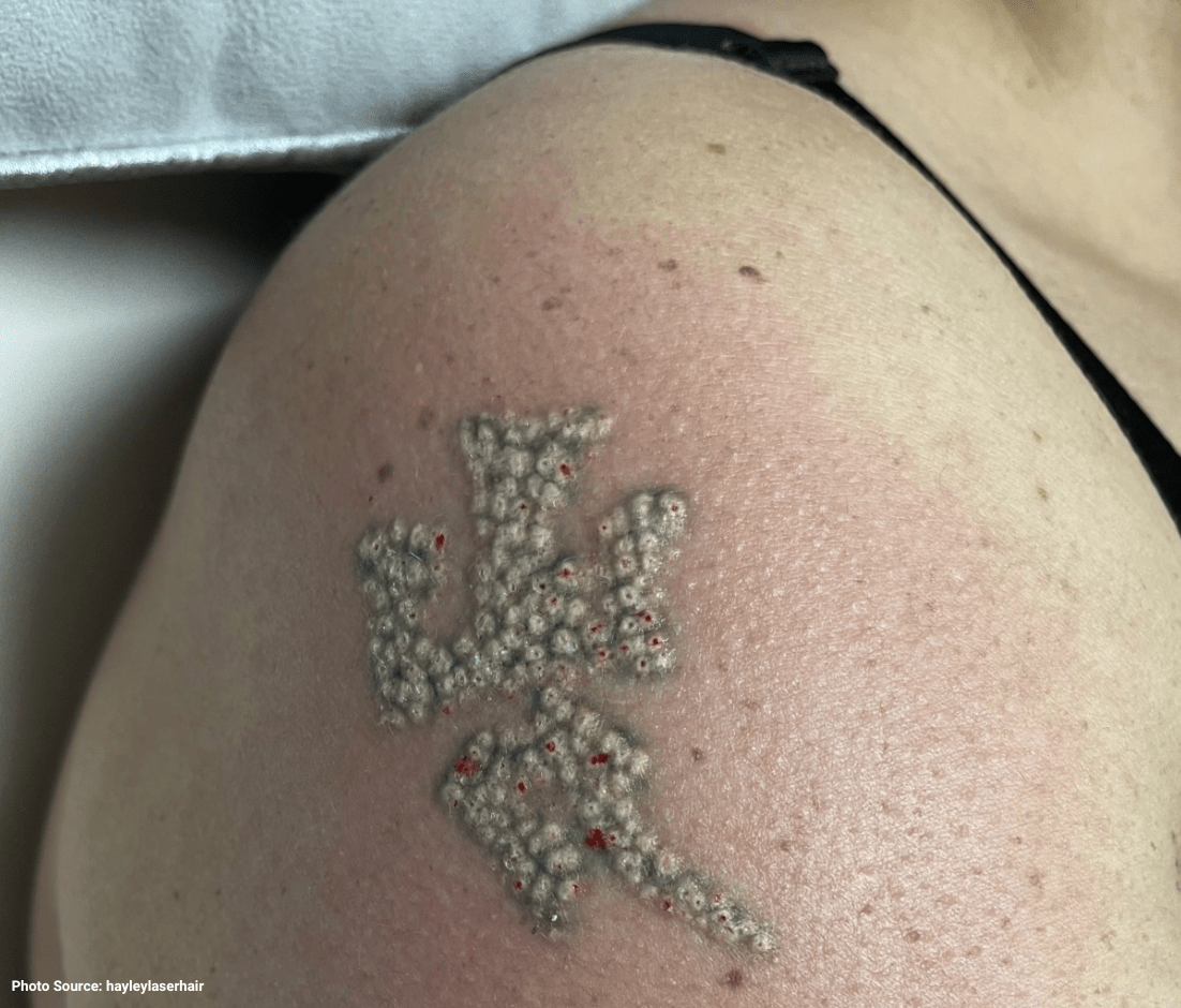 Does Laser Tattoo Removal Hurt: The Truth - Tatt2Away®