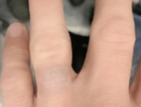 after ring tattoo removal