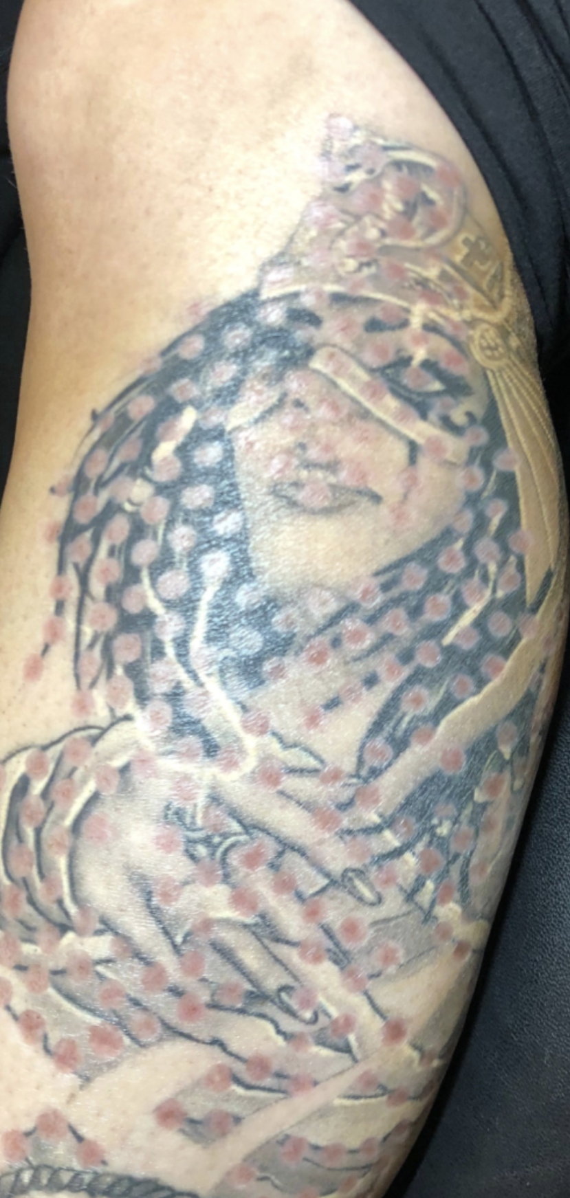 back of arm tattoo removal