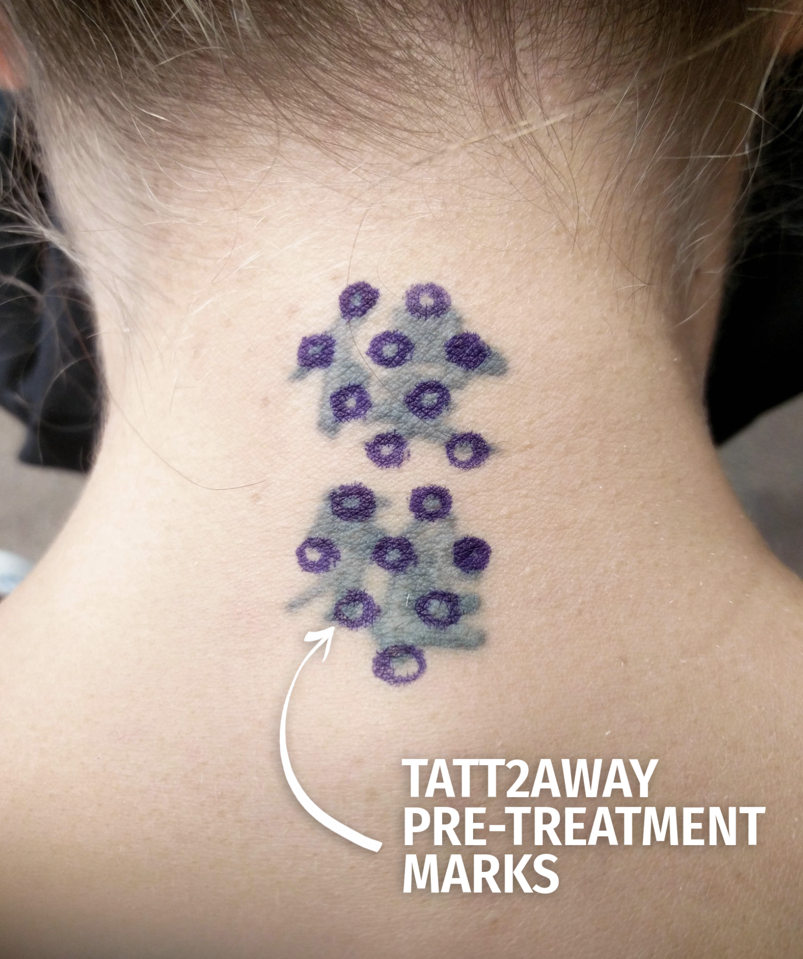 pre treatment tattoo removal dot pattern