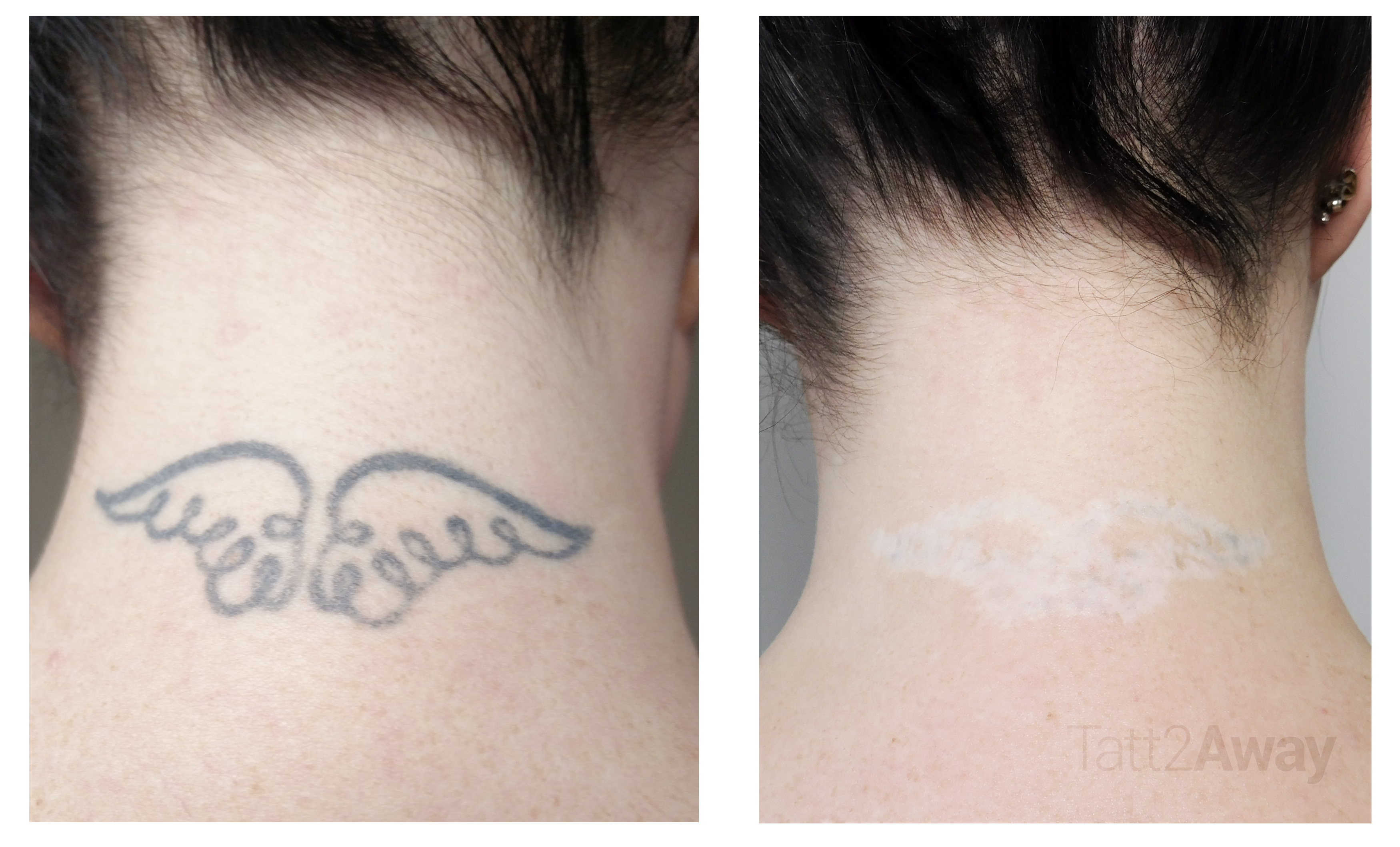 back of neck tattoo removal
