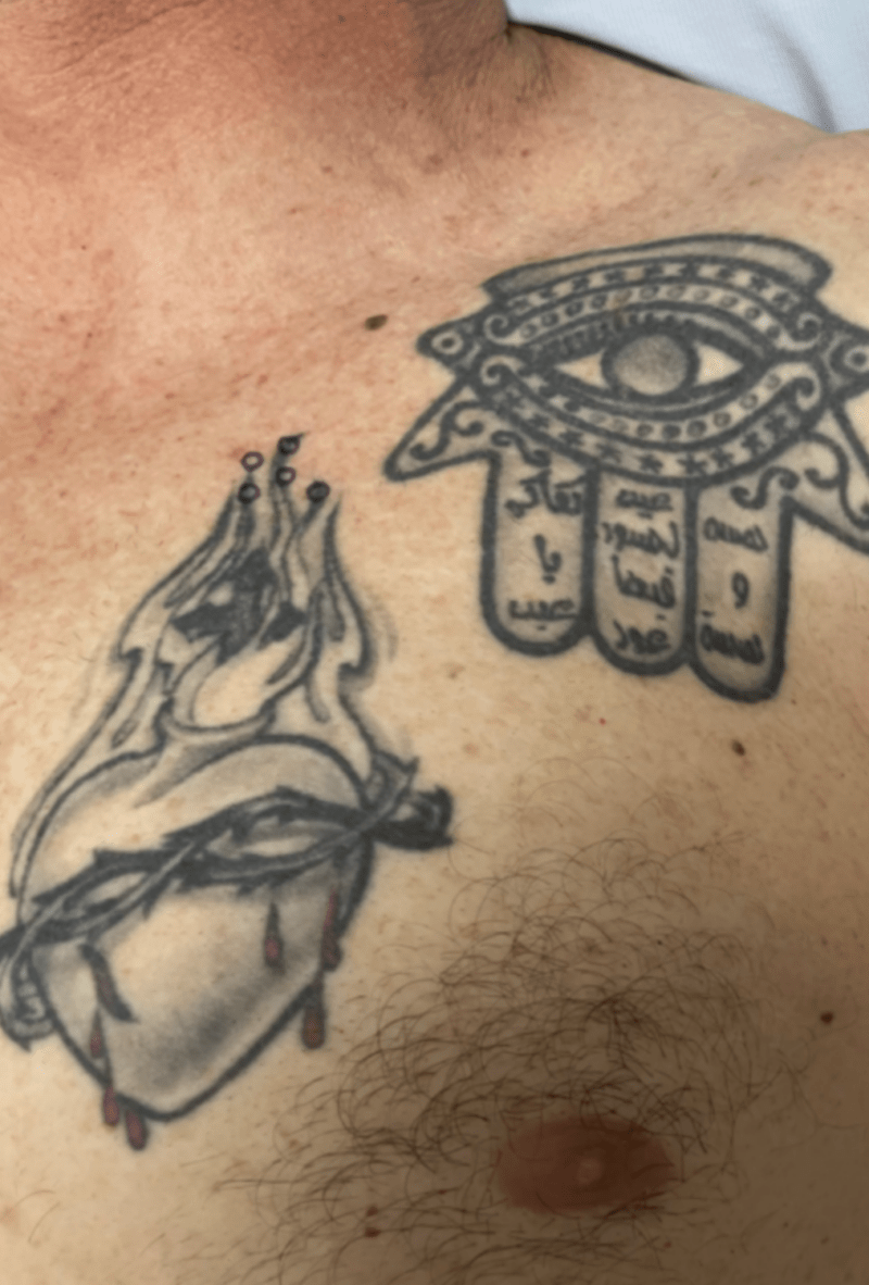 Tattoo Removal Before and After Pictures Tatt2Away®
