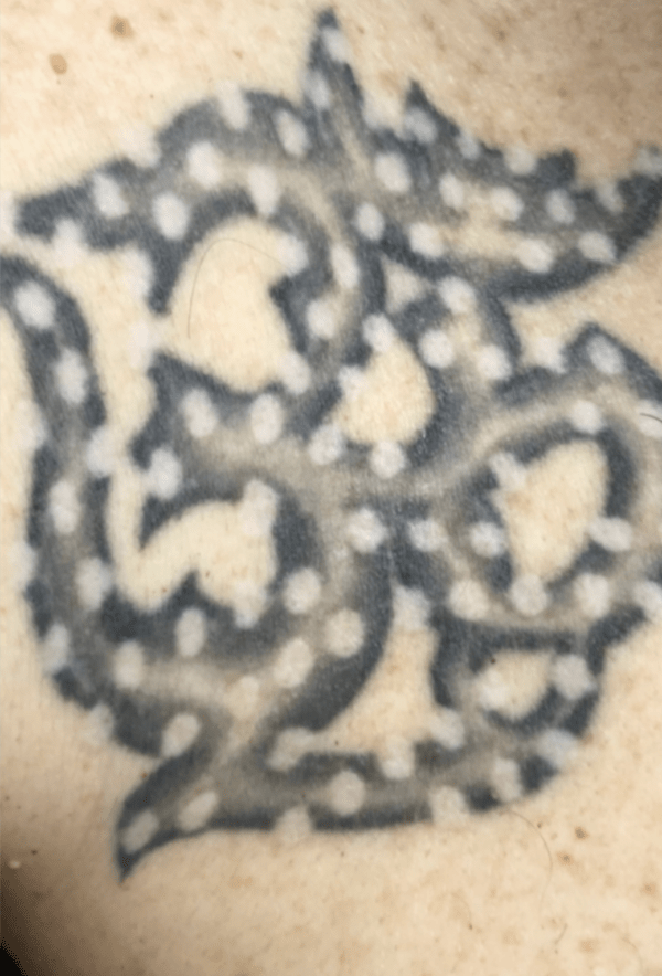 Tattoo Removal Before and After Pictures Tatt2Away®