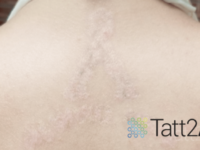 complete upper back tattoo removal