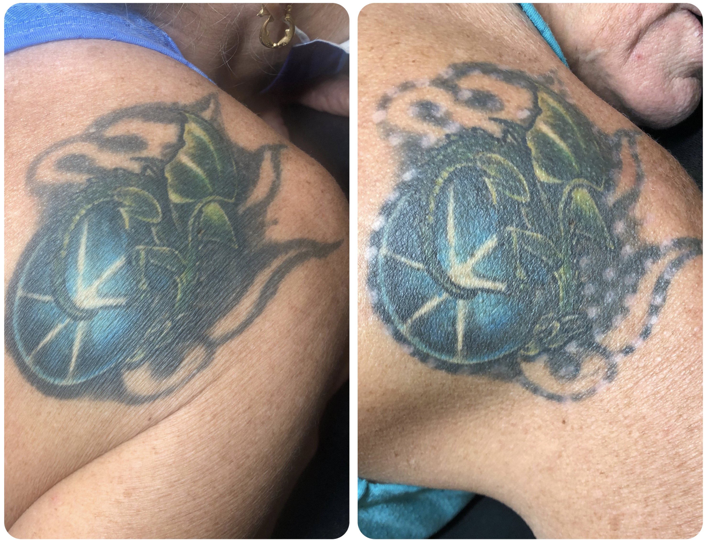 Shoulder Blade Colorful Tattoo Removal After First Session