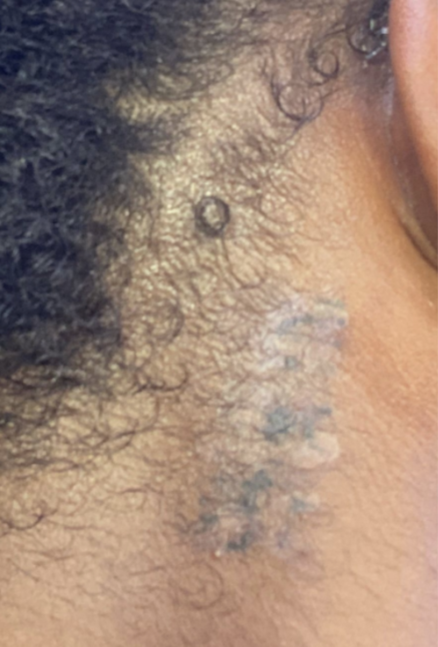 during a tattoo removal on darker skin