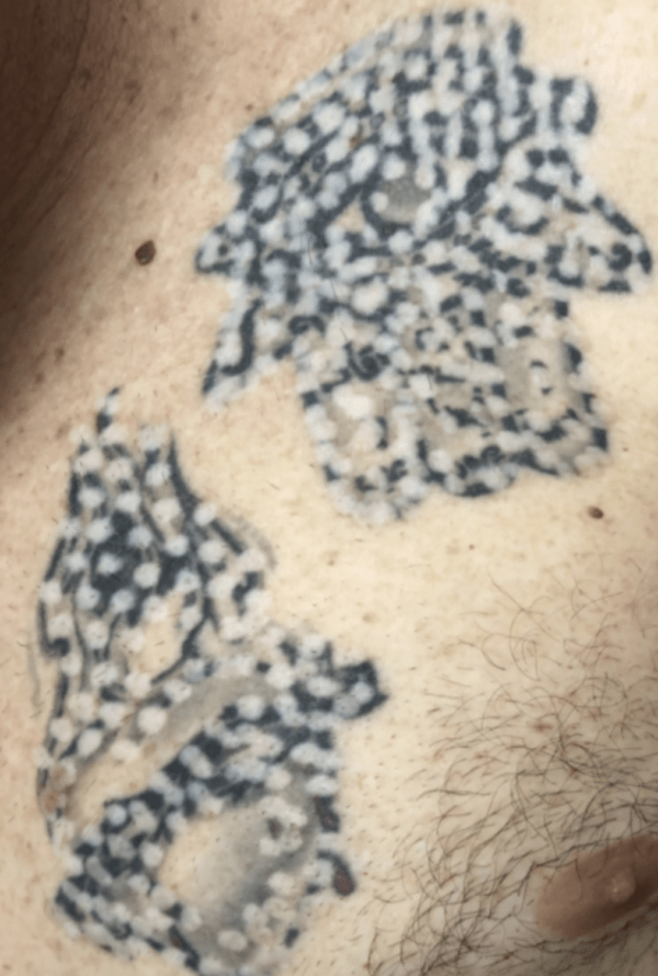 Tattoo Removal Before and After Pictures Tatt2Away®