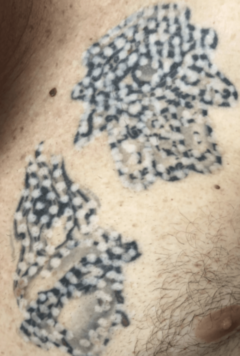 Tattoo Removal Before and After Pictures Tatt2Away®