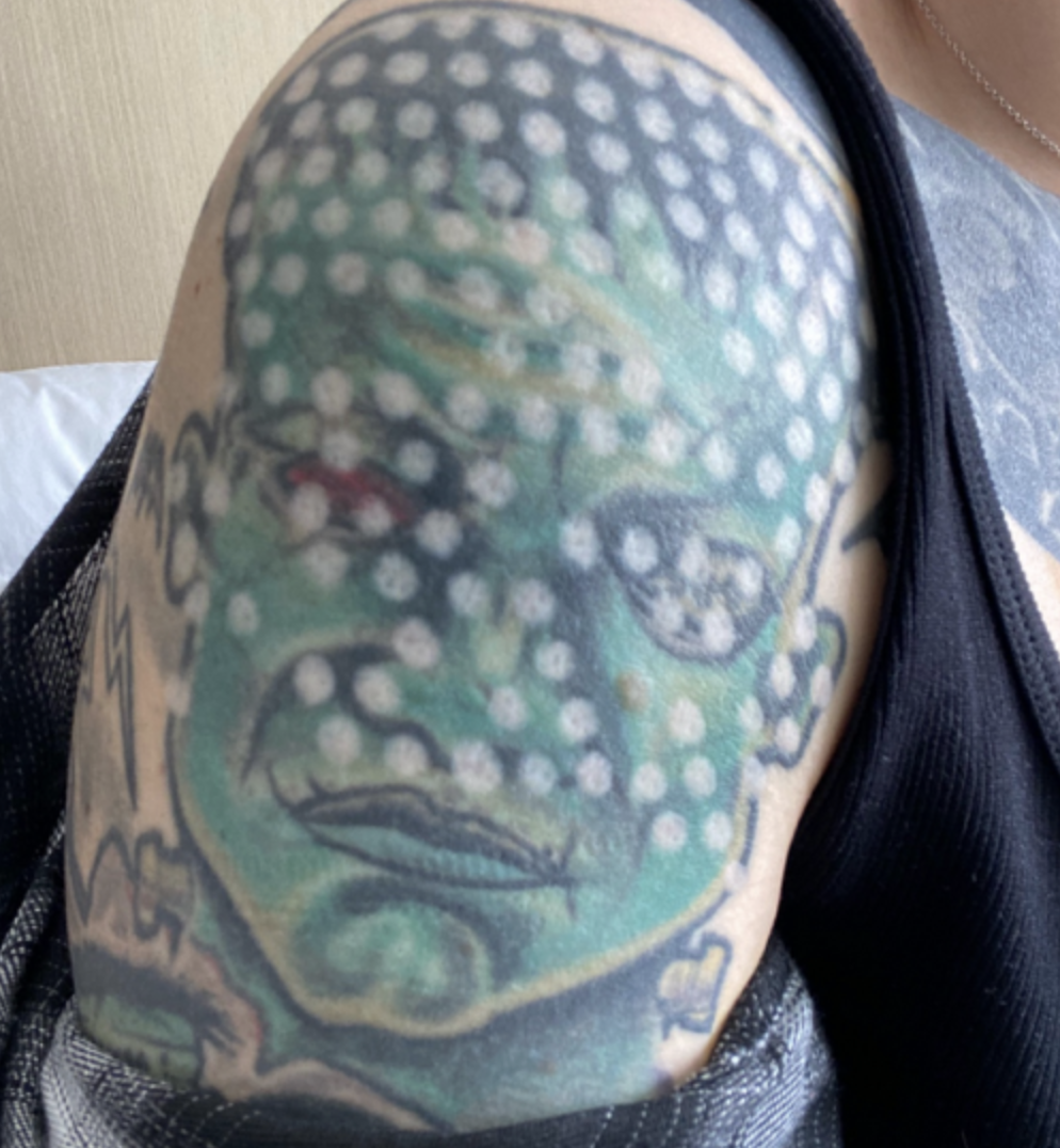frankenstein arm tattoo removal