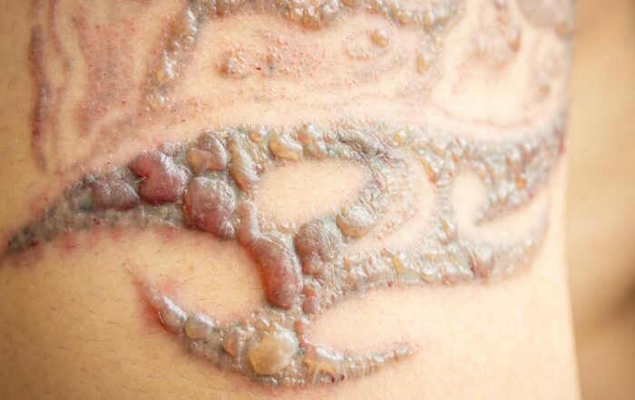 laser tattoo removal scars