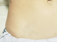 removal of scorpion tattoo on the waist