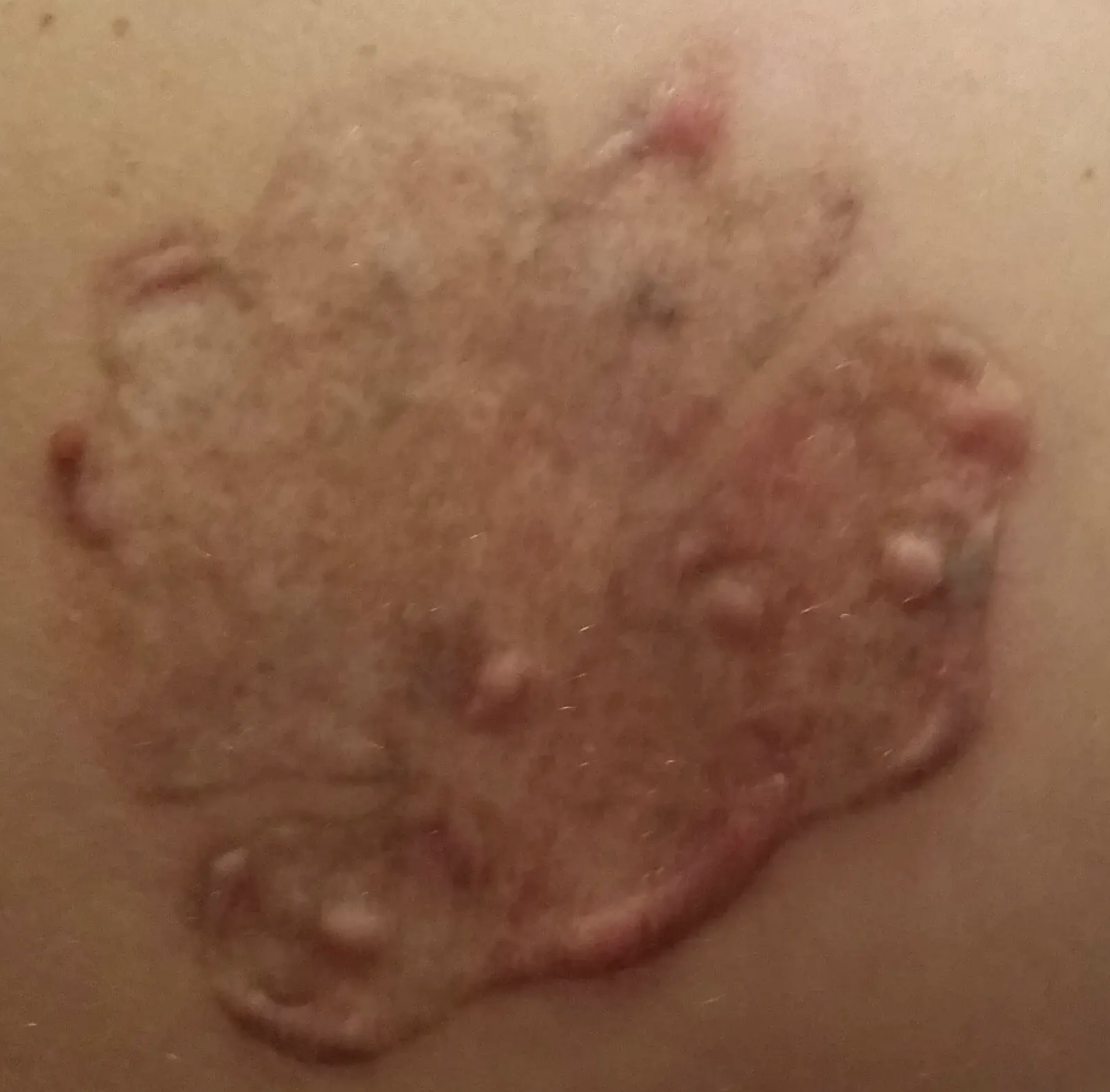 scarring from laser tattoo removal