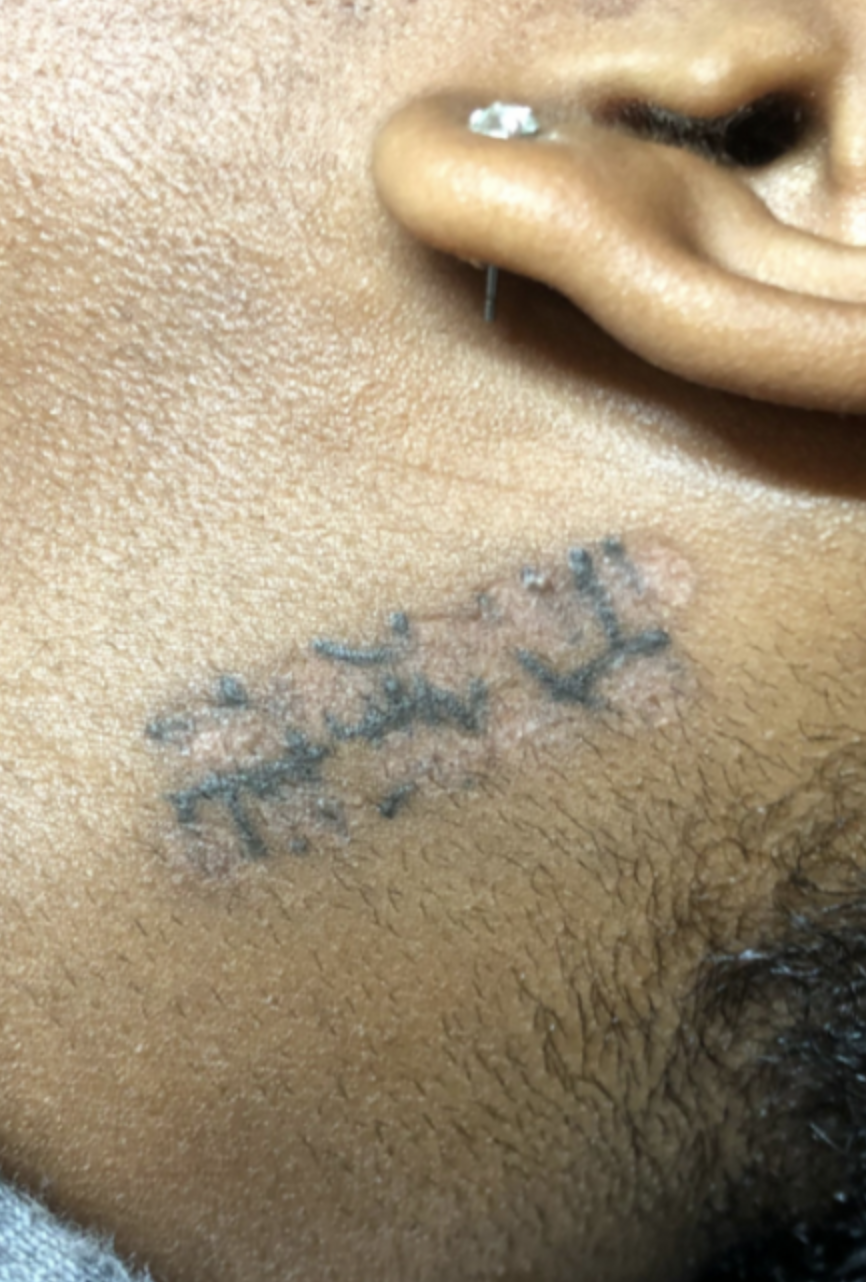 tattoo removal on darker skin