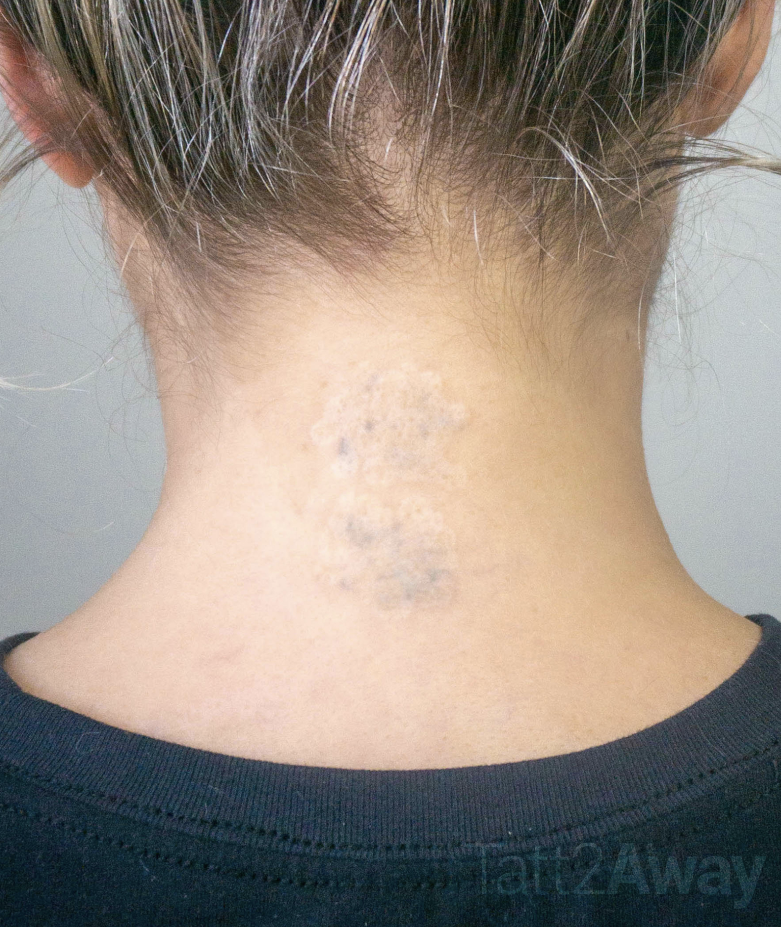 the back of neck tattoo removal with tepr non laser