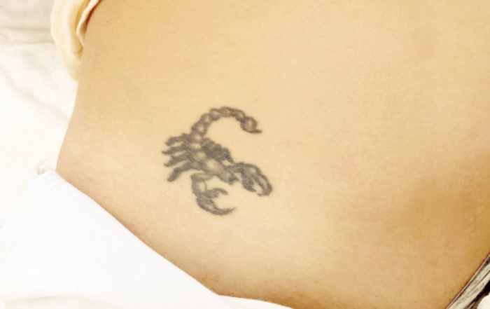 tattoo removal and how much it costs