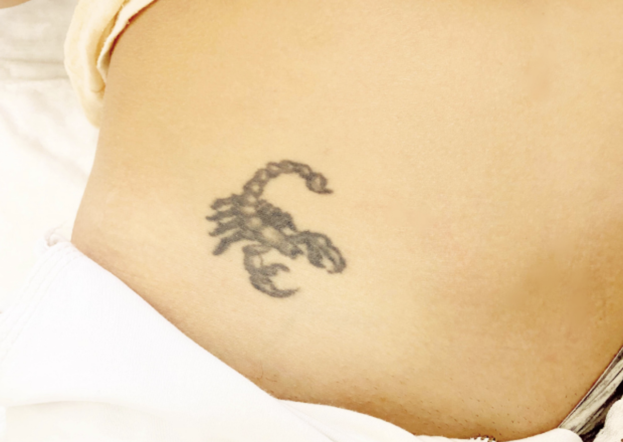 tattoo removal and how much it costs