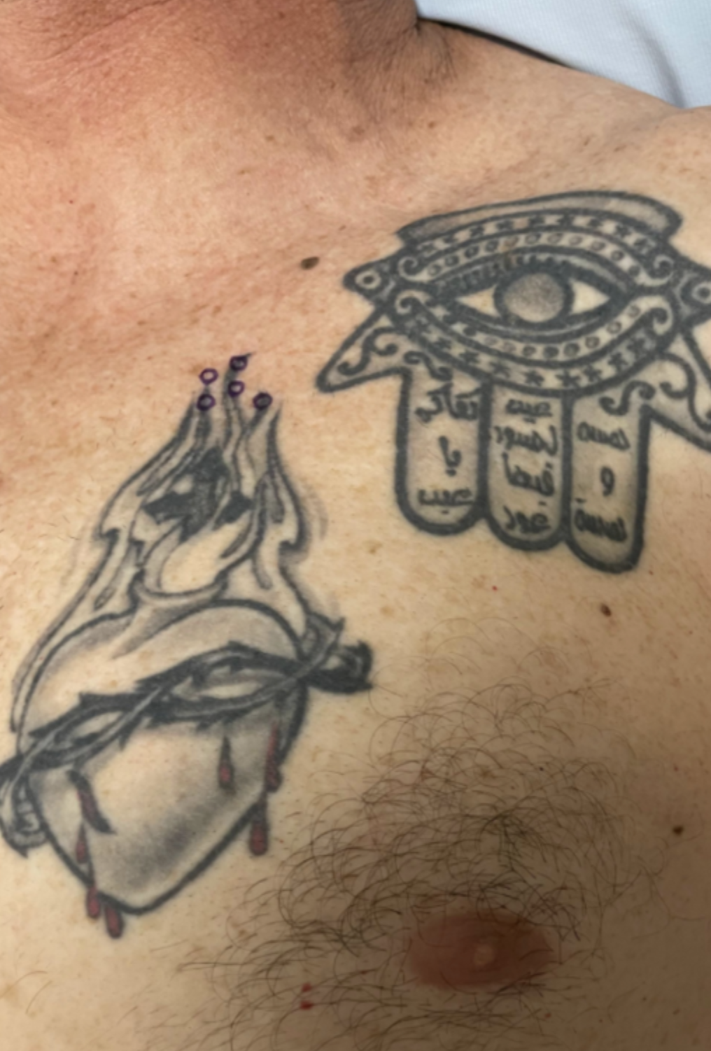 chest tattoo before removal